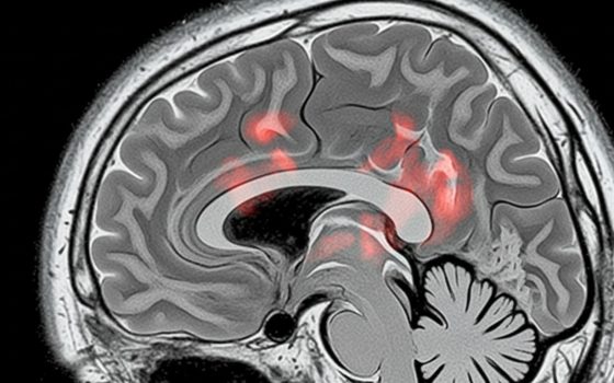 Brain MRI showing HIE: Hypoxic Ischaemic Encephalopathy with visible affected areas
