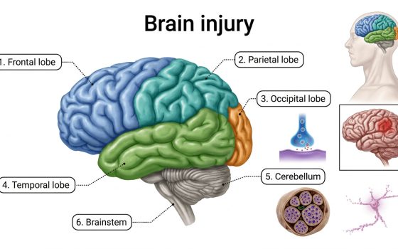Medical illustration showing a cross-section of the human brain highlighting areas affected by acquired brain injury